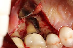 Figure 6: Molar tooth with three walls missing around the palatal root. This tooth would normally be extracted. Figure 6: Molar tooth with three walls missing around the palatal root. This tooth would normally be extracted.