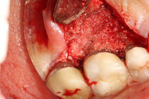 Figure 7: Same tooth undergoing periodontal regeneration surgery with anorganic bovine bone (Bio-Oss Collagen, Geistlich Biomaterials) and platelet-derived growth factor (PDGF)