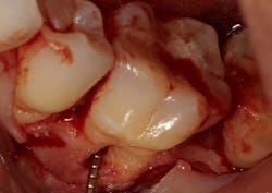 Figure 1a: Deep Class II furcation with an entrance smaller than the diameter of a curette tip Figure 1a: Deep Class II furcation with an entrance smaller than the diameter of a curette tip