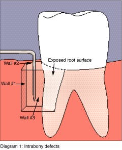 Figure 5: Graphic shows type of walls remaining around a tooth affected with periodontal disease Figure 5: Graphic shows type of walls remaining around a tooth affected with periodontal disease