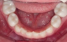 Content Dam De En Articles Print Volume 106 Issue 3 Science Tech Pediatric Zirconia Crowns Changing Pediatric Restorative Dentistry Leftcolumn Article Thumbnailimage File