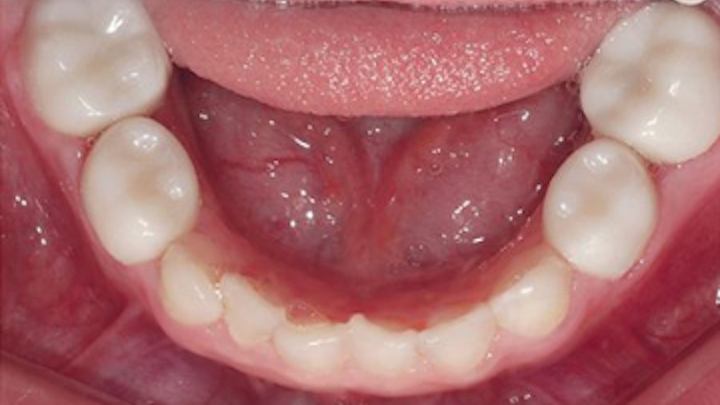 Content Dam De En Articles Print Volume 106 Issue 3 Science Tech Pediatric Zirconia Crowns Changing Pediatric Restorative Dentistry Leftcolumn Article Thumbnailimage File