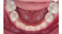 Content Dam De En Articles Print Volume 106 Issue 3 Science Tech Pediatric Zirconia Crowns Changing Pediatric Restorative Dentistry Leftcolumn Article Thumbnailimage File