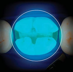 Content Dam De En Articles Print Volume 107 Issue 12 Science Tech Don T Take Light Curing For Granted Improper Curing Can Lead To Failure Leftcolumn Article Thumbnailimage File Content Dam De En Articles Print Volume 107 Issue 12 Science Tech Don T Take Light Curing For Granted Improper Curing Can Lead To Failure Leftcolumn Article Thumbnailimage File