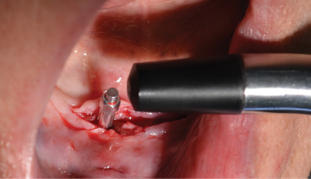 Content Dam De En Articles Print Volume 107 Issue 12 Science Tech Implant Stability Prior To Loading Implant Overdentures Leftcolumn Article Thumbnailimage File
