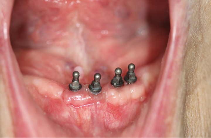 Content Dam De En Articles Print Volume 107 Issue 12 Science Tech Mini Implant Retained Overdenture And The Chairside Soft Reline Leftcolumn Article Thumbnailimage File