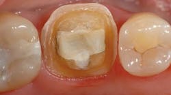 Content Dam De En Articles Print Volume 107 Issue 1 Science Tech A Dynamic Duo Maximizing Workflow And Clinical Success With Celtra Duo Calibra Ceram And Prime Bond Elect Leftcolumn Article Thumbnailimage File Content Dam De En Articles Print Volume 107 Issue 1 Science Tech A Dynamic Duo Maximizing Workflow And Clinical Success With Celtra Duo Calibra Ceram And Prime Bond Elect Leftcolumn Article Thumbnailimage File