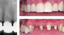 Content Dam De En Articles Print Volume 108 Issue 2 Science Tech Ask Dr Christensen What Material Should I Use For An Anterior Three Unit Fixed Prosthesis Leftcolumn Article Thumbnailimage File