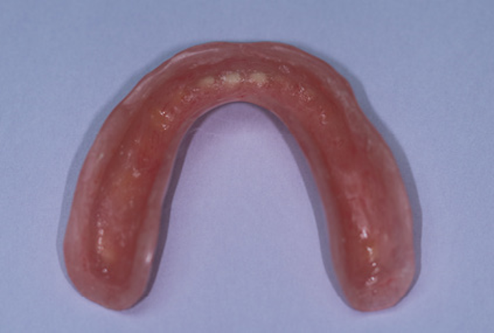 Economic Management Of The Ill Fitting Denture The Hard Soft