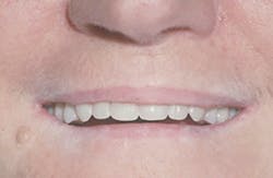 Content Dam De En Articles Print Volume 108 Issue 3 Science Tech If And When Should Vertical Dimension Of Occlusion Be Increased Leftcolumn Article Thumbnailimage File Content Dam De En Articles Print Volume 108 Issue 3 Science Tech If And When Should Vertical Dimension Of Occlusion Be Increased Leftcolumn Article Thumbnailimage File