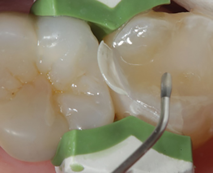 Content Dam De En Articles Print Volume 108 Issue 3 Science Tech Simplifying Posterior Composite Placement Using Bulk Fill Technologies Leftcolumn Article Thumbnailimage File