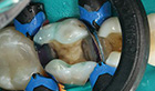 Efficient posterior restorations with selective etching, universal