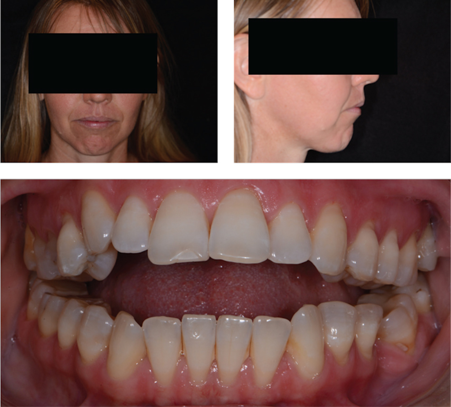 TMJ deformation and airway dysfunction A dental occlusion case study