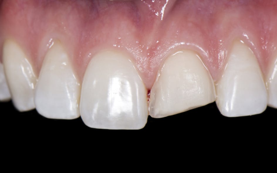 Predictable techniques for single provisional veneers Dental Economics