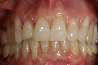 Case Study: Composite Front Teeth Repairs