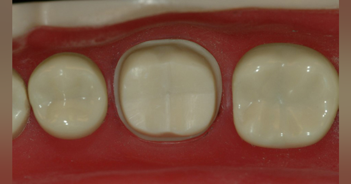 Making Optimal Zirconia Crowns Dental Economics Making Optimal Zirconia Crowns Dental Economics