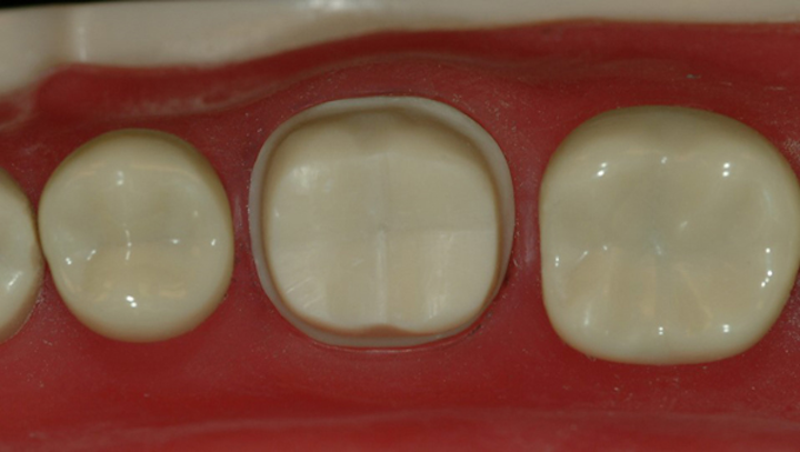Making Optimal Zirconia Crowns Dental Economics