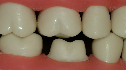 Making Optimal Zirconia Crowns Dental Economics