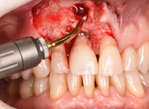 Lasers in dentistry: Hard-tissue applications | Dental Economics