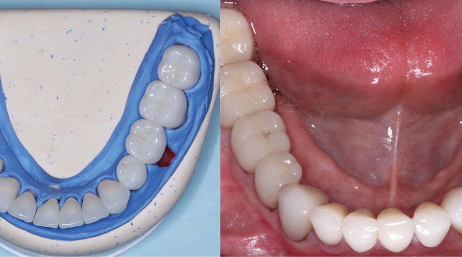 Figures 1 and 2: The restorations on the molars are Class 5 zirconia colored in the presintered stage, nonglazed or superficially stained. They are polished only. The restorations cannot be differentiated from the lithium disilicate restorations on the remainder of the teeth and implants. Note the lack of simulated caries on the occlusal surfaces, which is discouraged. Natural teeth without caries do not have occlusal color. Technicians: Jed and John Archibald; Archibald Associates; Orem, Utah. Clinician: Gordon Christensen, DDS, prosthodontist.