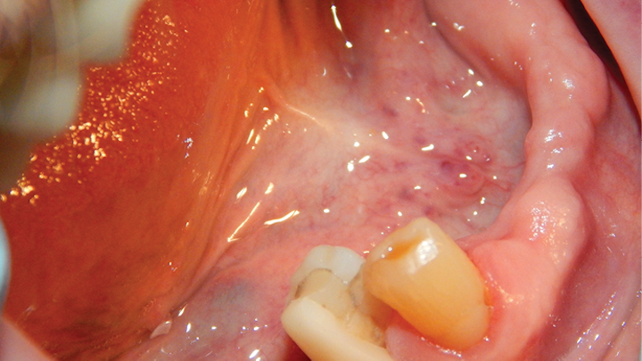 Figure 1: No. 28 crown that had fractured after root canal therapy was completed