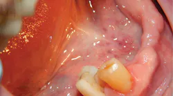 Figure 1: No. 28 crown that had fractured after root canal therapy was completed