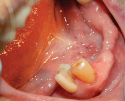 Figure 1: No. 28 crown that had fractured after root canal therapy was completed Figure 1: No. 28 crown that had fractured after root canal therapy was completed