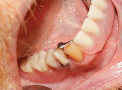 Figure 2: The removable partial denture in place showing the importance of the contours