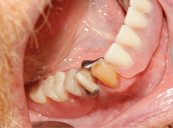 Figure 2: The removable partial denture in place showing the importance of the contours Figure 2: The removable partial denture in place showing the importance of the contours