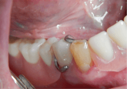 Figure 4: No. 28 crown and removable partial denture in place to check for fit and form
