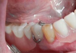 Figure 4: No. 28 crown and removable partial denture in place to check for fit and form Figure 4: No. 28 crown and removable partial denture in place to check for fit and form