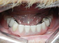 Figure 5: Both Nos. 27 and 28 in place with the removable partial denture