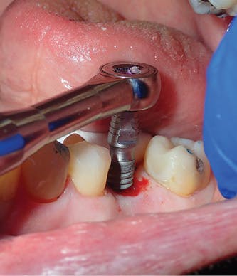 Figure 7: After simplified osseocompatible drilling protocol placement of an iHex 1 implant (iH Biomedical)