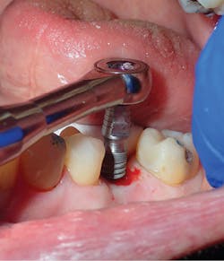 Figure 7: After simplified osseocompatible drilling protocol placement of an iHex 1 implant (iH Biomedical) Figure 7: After simplified osseocompatible drilling protocol placement of an iHex 1 implant (iH Biomedical)