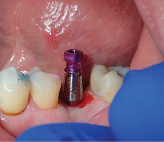 Figure 8: iHex 1 comes packaged with a specialized abutment/transfer with a cervical contour that allows for reduced/eliminated bone and tissue impingement for subcrestal placement, if desired. Cervical contour also allows for improved esthetics at the abutment/soft-tissue interface.