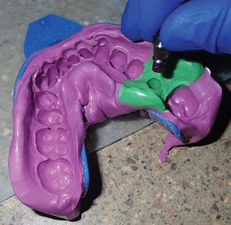Figure 9: After closed-tray impression (open-tray impressions also work with this transfer), remove the abutment/transfer from the implant and insert into the impression.