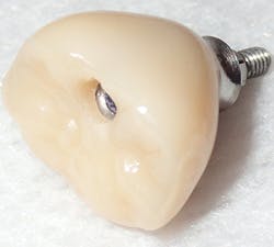 Figure 10: Final full-contour zirconia implant crown ($59 implant mastery pricing, ddsinstitute.com) cemented to the lab-modified abutment ($41 implant mastery pricing, ddsinstitute.com) Figure 10: Final full-contour zirconia implant crown ($59 implant mastery pricing, ddsinstitute.com) cemented to the lab-modified abutment ($41 implant mastery pricing, ddsinstitute.com)