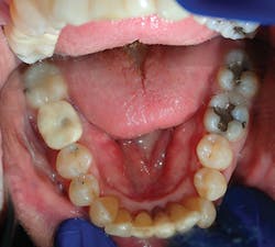 Figure 11: Seated restoration. Note the access hole in the crown is minimized with this single-unit zirconia crown, which is an efficient prosthetic technique. Figure 11: Seated restoration. Note the access hole in the crown is minimized with this single-unit zirconia crown, which is an efficient prosthetic technique.