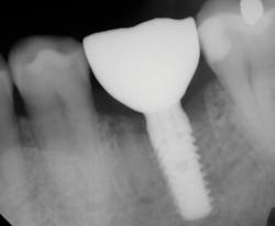 Figure 12: Final radiograph of seating three months from placement, demonstrating subcrestal placement, solid marginal adaptation, and a cervical contour to maximize esthetics and minimize bone loss Figure 12: Final radiograph of seating three months from placement, demonstrating subcrestal placement, solid marginal adaptation, and a cervical contour to maximize esthetics and minimize bone loss