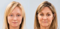 Figure 1: Comparison photo of a mother and daughter demonstrating facial aging.