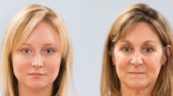 Figure 1: Comparison photo of a mother and daughter demonstrating facial aging.