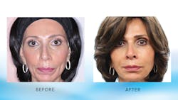 Figure 5: Before and after photos at rest demonstrating results of Botox, dermal filler, and PDO threadlift treatment.