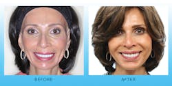Figure 6: Before and after smiling photos also show the improvement of the lip and smile lines after facial injectable therapy.