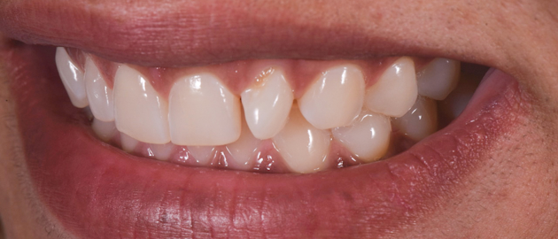 Zirconia vs. lithium disilicate | Dental Economics