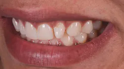 Figure 1: Lateral smile view