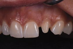 Figure 2: Lateral retracted view of prepped lateral incisor, No. 10 Figure 2: Lateral retracted view of prepped lateral incisor, No. 10