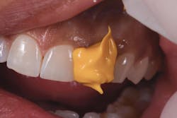 Figure 3: Application of Honigum Pro-Light Figure 3: Application of Honigum Pro-Light