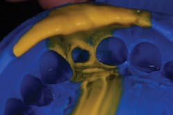 Figure 4: Application of Honigum Pro-Heavy Figure 4: Application of Honigum Pro-Heavy