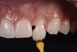 Figure 5: Extrusion of excess TempoCem ID during initial setting phase Figure 5: Extrusion of excess TempoCem ID during initial setting phase