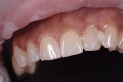 Figure 6: Removal of excess cement in one piece after curing one to two seconds Figure 6: Removal of excess cement in one piece after curing one to two seconds